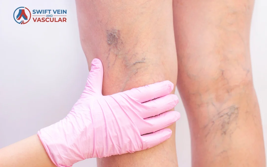 Deep Vein Thrombosis (DVT): Early Signs You Should Never Ignore