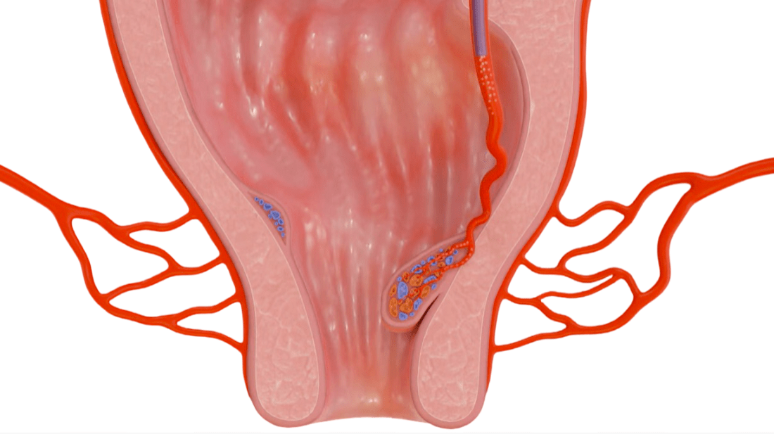 Hemorrhoidal embolization