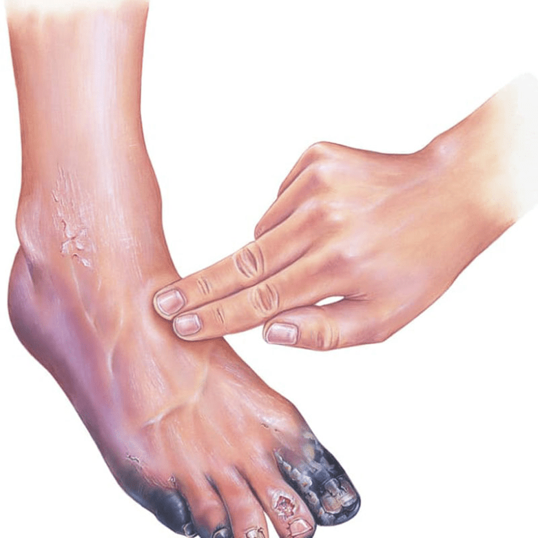 Peripheral Artery Disease