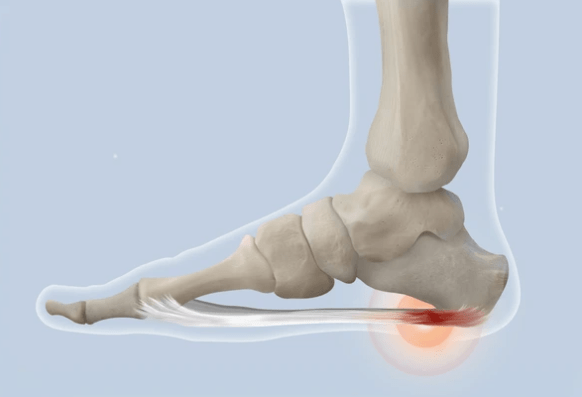Plantar Fasciitis Embolization