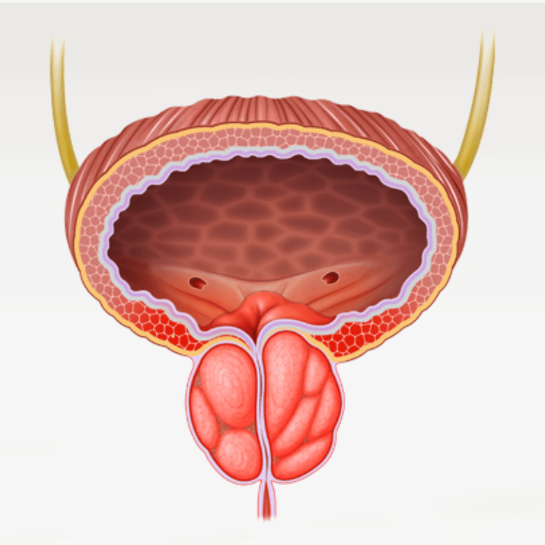 Prostate Artery Embolization