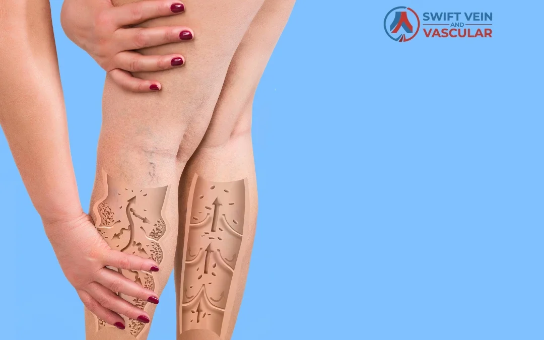 Understanding Varicose Veins: Causes, Symptoms & Modern Treatment Options