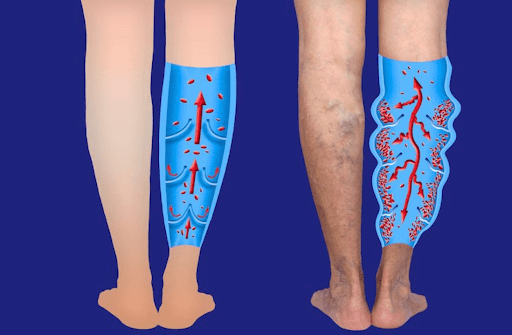 Varicose Veins